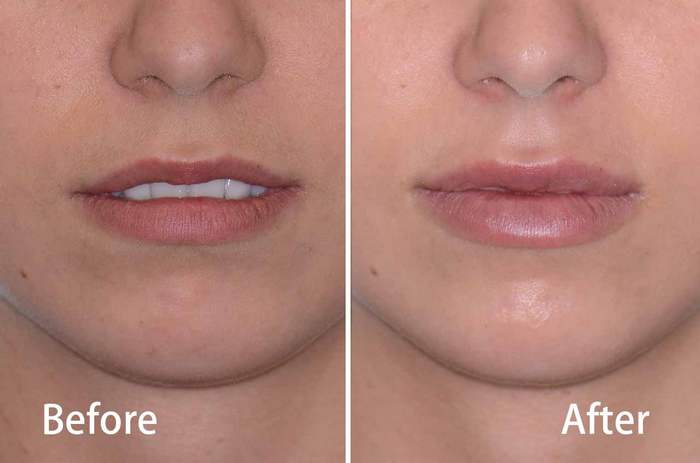 Some Ideas on What Is Juvederm? - South Nassau Dermatology You Should Know thumbnail